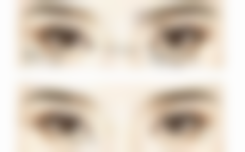 做双眼皮后眼皮会松弛吗？揭秘影响因素与抗松弛妙招，让美更持久 