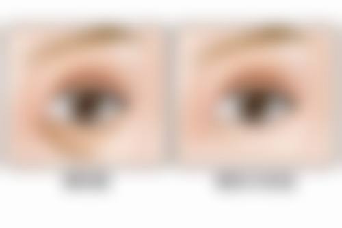 腿部抽脂风险可控吗？正规医院保护，降低感染风险