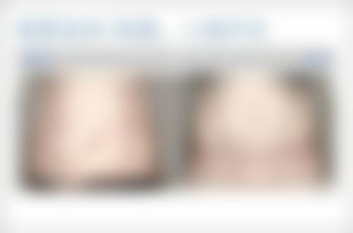 减少双眼皮术后眼皮松弛风险的妙招