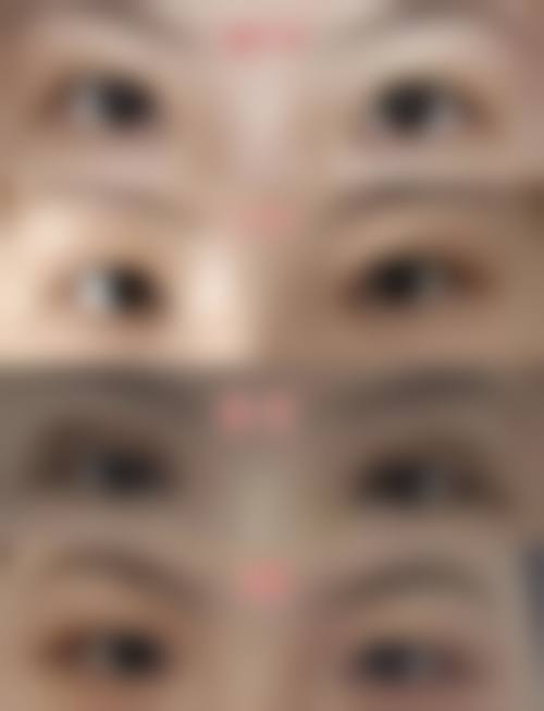 秦波澜眼部整形实例