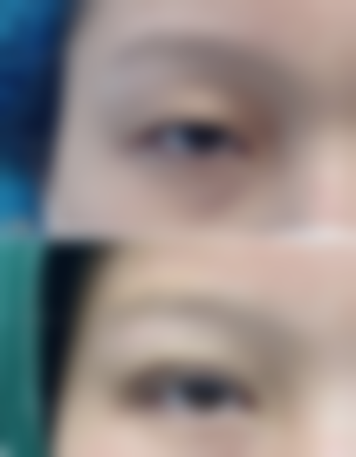 秦波澜眼部整形水平怎么样可靠吗？