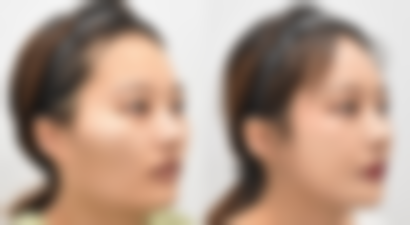 疤痕增生如何医疗？手术治疗解难题