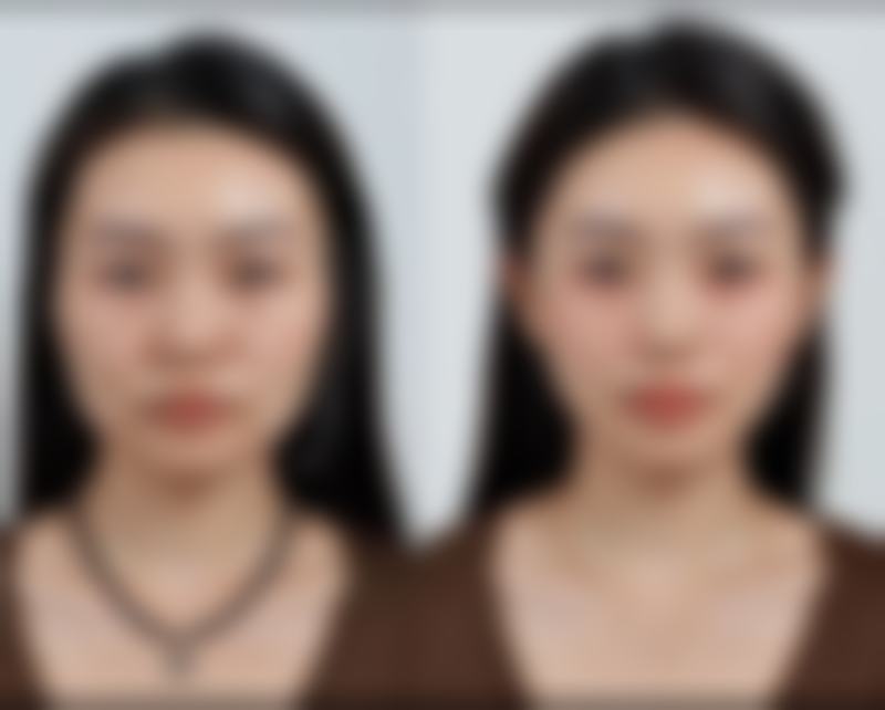 疤痕增生如何医疗？日常护理不能忘