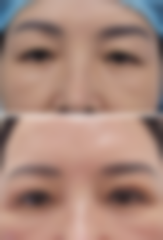 想割双眼皮？个人因素也特别关键