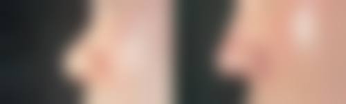 告别多年顽固眼袋，重拾自信光彩！