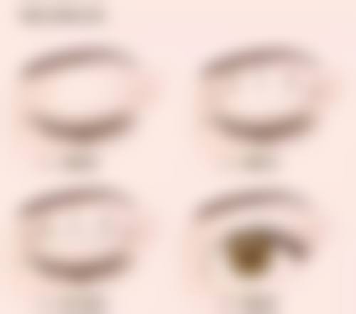 双眼皮埋线与切开咋选？成效持久有不同