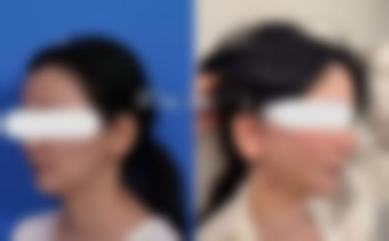 全切双眼皮红色线多久消失？答案在这，还揭秘促进红色线快速消退秘诀 