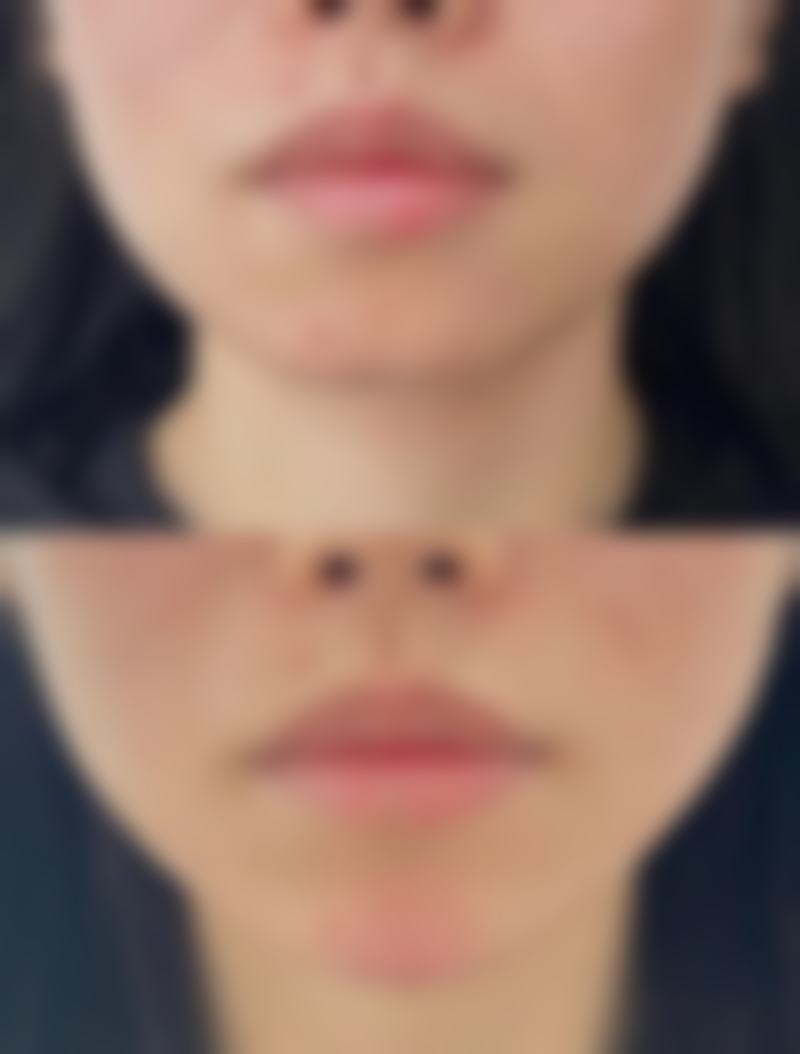 割完双眼皮拆线后多久能洗脸？医院相关信息介绍