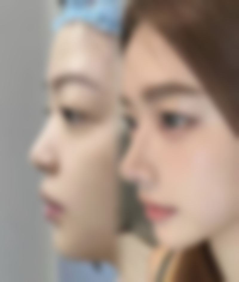 双眼皮埋线与切开咋定？修复时间有快慢