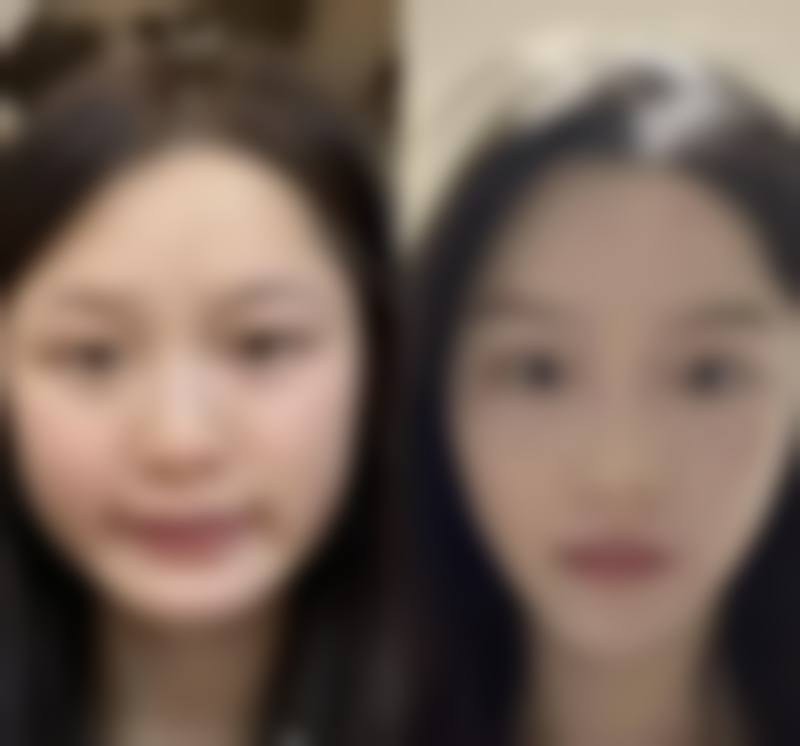 全切双眼皮不同阶段红色线情况及修复时间！快速消退秘诀大公开