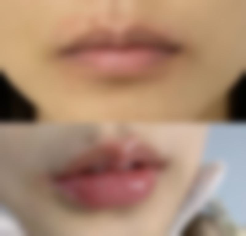 疤痕修复时间大揭秘：护理措施加速疤痕修复