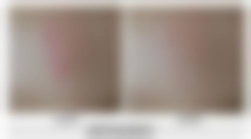 减肥后眼袋冒出来？选择合适医院特别重要