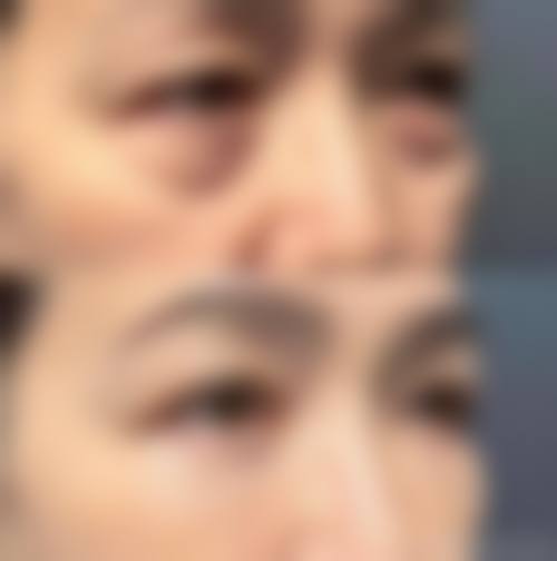 张科军眼部整形实例