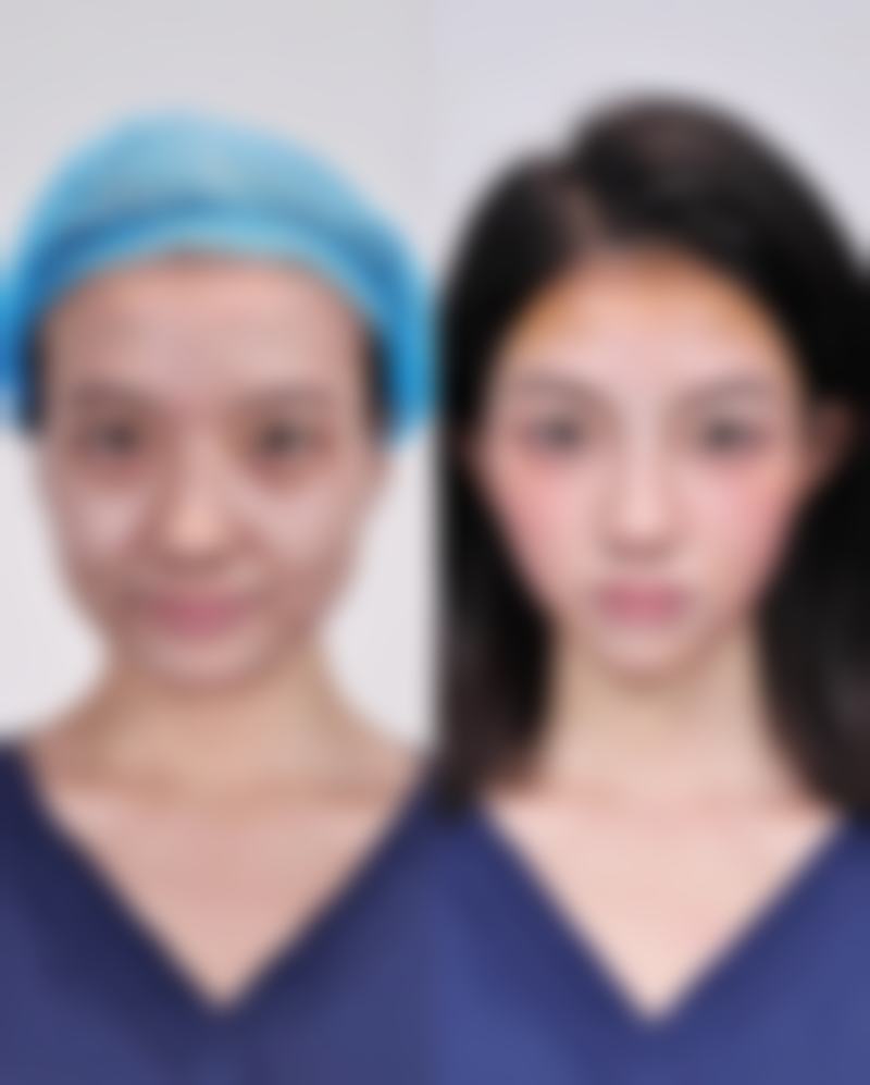 减肥后眼袋冒出来？眼部护理有妙招