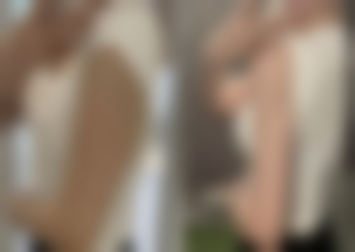 半恒久双眼皮埋线的适应人群和美学要求