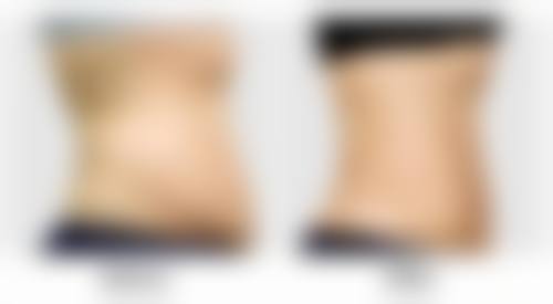 多种方法助您去除疤痕！激光治疗——精细改善疤痕外观