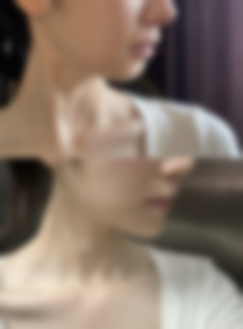 39岁有眼袋别愁！医美方案大揭秘