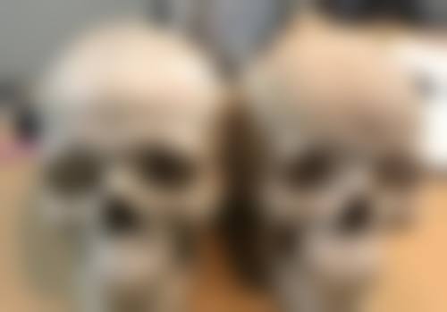 吴国兴义齿修复实例