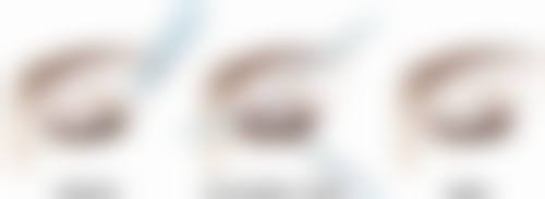 割双眼皮修复时间大揭秘总结！多因素综合影响成效