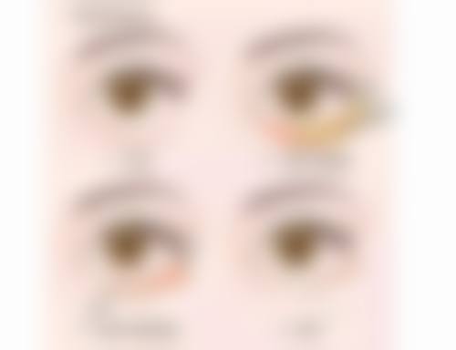 割双眼皮修复时间这样把控！术后护理是加速秘诀