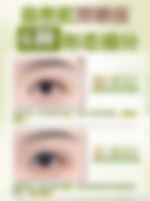 张科军眼部整形实例