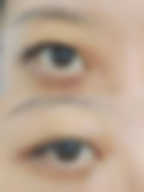 赵世平面部微整形实例