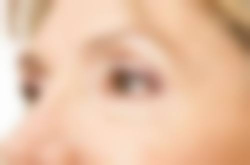 郭长元面部除皱实例