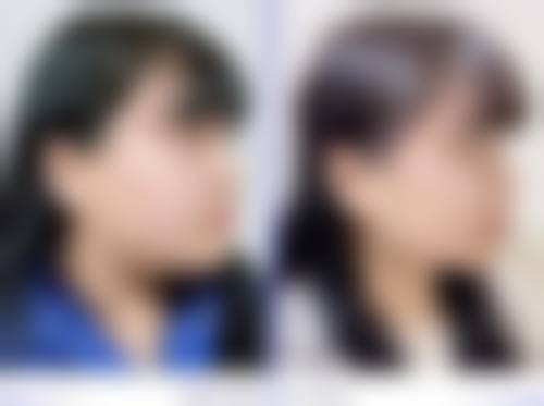 王艳成面部常规手术实例