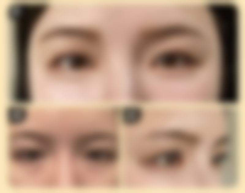 肿泡眼割双眼皮效果究竟如何？解析手术优势及优质医院选择要点 