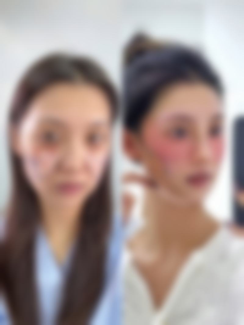 隆胸假体破裂会怎样？搞清楚原因才能做好评估！