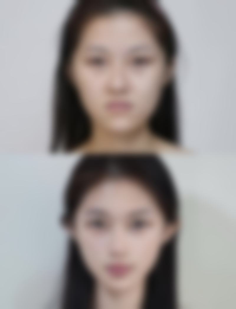 肿泡眼割双眼皮术后修复与成效保护