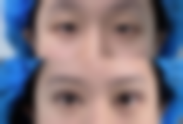 金圣浩眼部整形实例