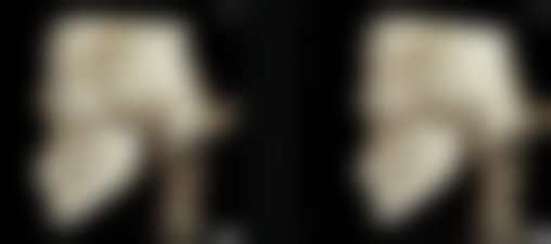 假体隆胸风险究竟几何？术后护理与长期成效