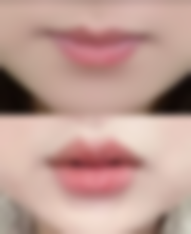 五、长沙美沃整形医疗美容实例