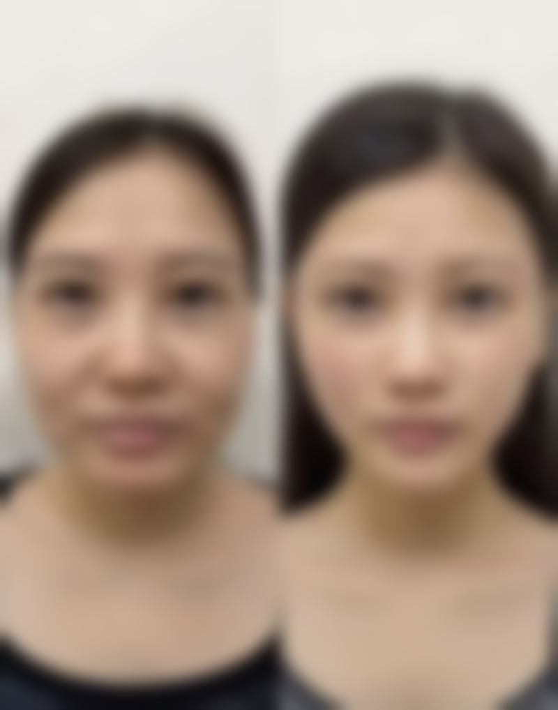 肿泡眼割双眼皮的手术优势大揭秘