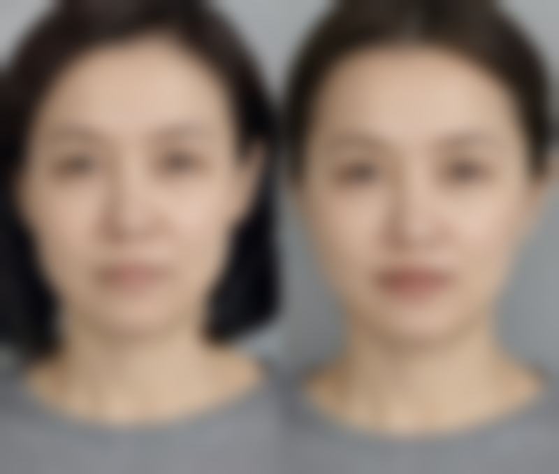 割双眼皮不会遗传下一代，揭秘医院割双眼皮优势、遗传概率及术后恢复要点 