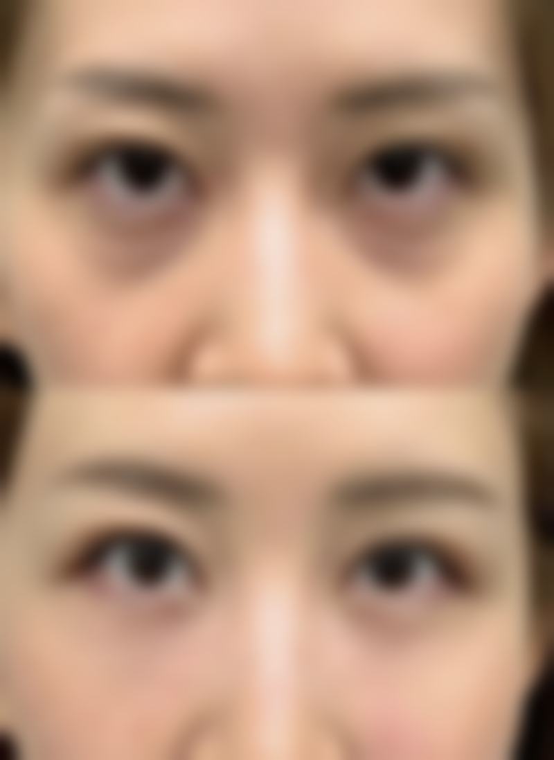 假体隆胸破裂是否有感觉？不同假体渗漏表现大不同