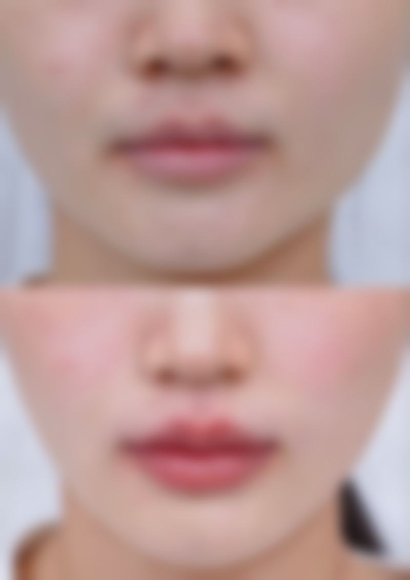 背上痘疤凸起难题怎么破？正规医院的治疗手段