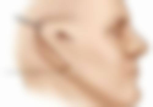 烫伤增生疤痕疙瘩能否自愈？日常护理有妙招