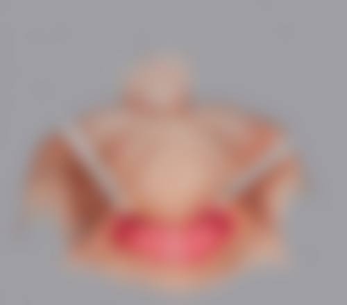 肥胖吸脂手术塑形成效如何？安心保护有成效