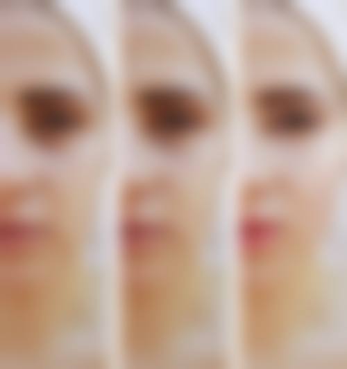 郭长元面部除皱实例