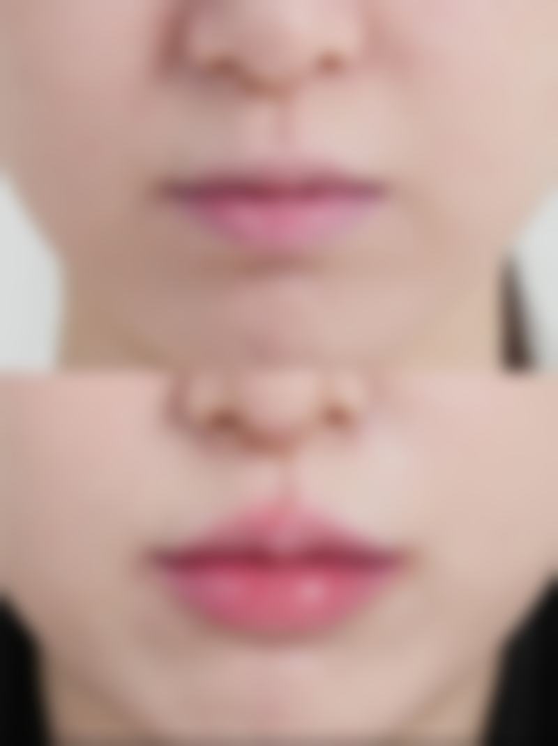 揭秘开双眼皮的感染问题