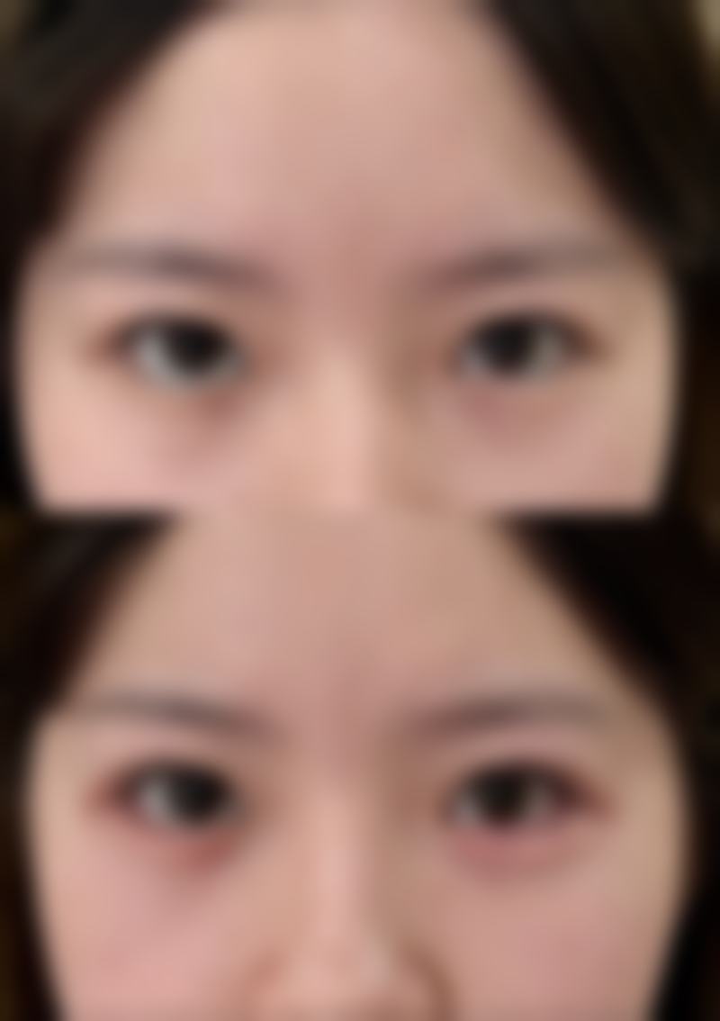 正规操作怎样降低肥胖吸脂手术风险？多维度保护给力