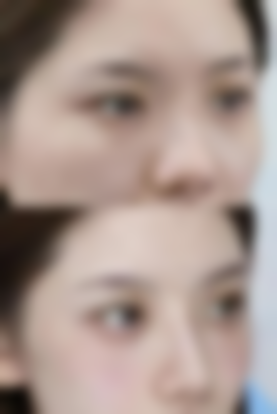 双眼皮切开和埋线怎么选？选对医院医生特别重要