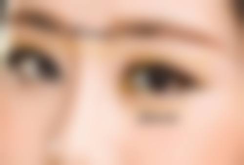 张科军眼部整形实例