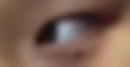 割完双眼皮后何时能安心敷面膜？按阶段精细调养，助您早日恢复美肌状态 