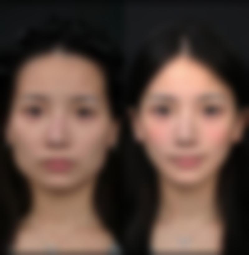 金钟瑞韩式隆鼻实例