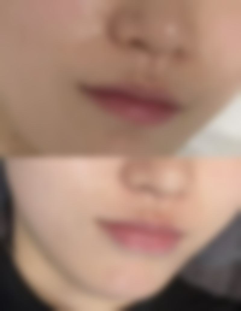 不忌口促进瘢痕增生