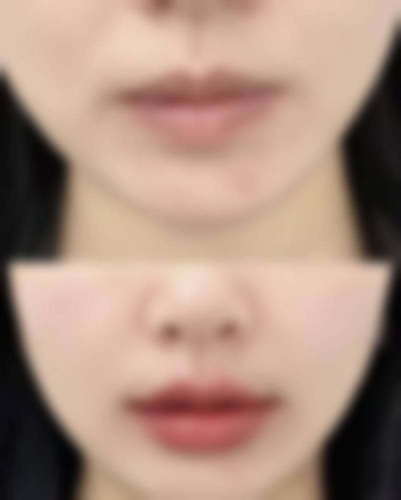 疤痕疙瘩真能去掉吗？多种治疗手段结合，有效改善外观、控制增生！ 