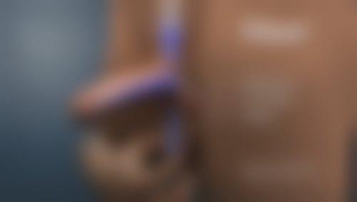 凹陷性疤痕修复不是梦！开启光滑肌肤之旅